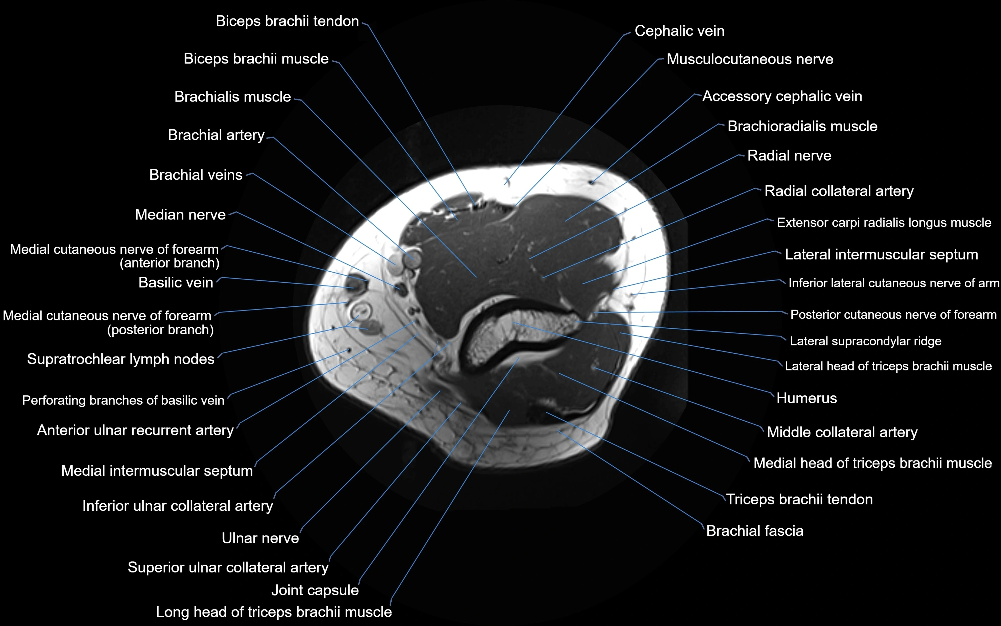 MRI elbow axial cross sectional anatomy 3T  radiology  image-img-00001-00006.webp